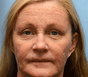 Tillverkad och skickad från Sverige🌟 Awzlove™ Botox Bigift Rynkborttagningskräm🌟 - 🔥 SISTA DAGEN 70 % RABATT